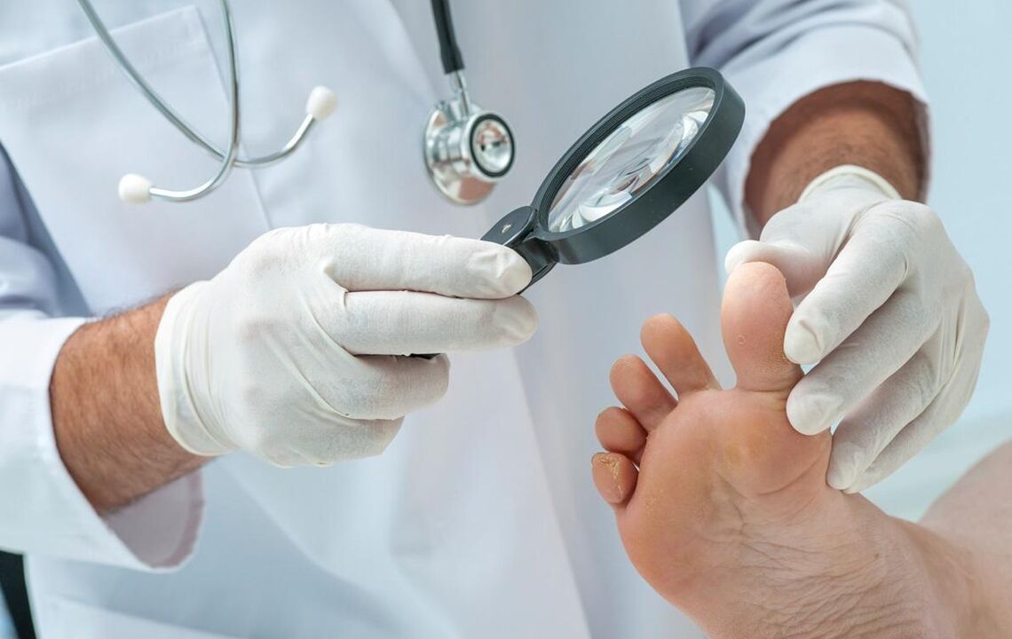 doktor tırnaklarda mantar olup olmadığını inceliyor